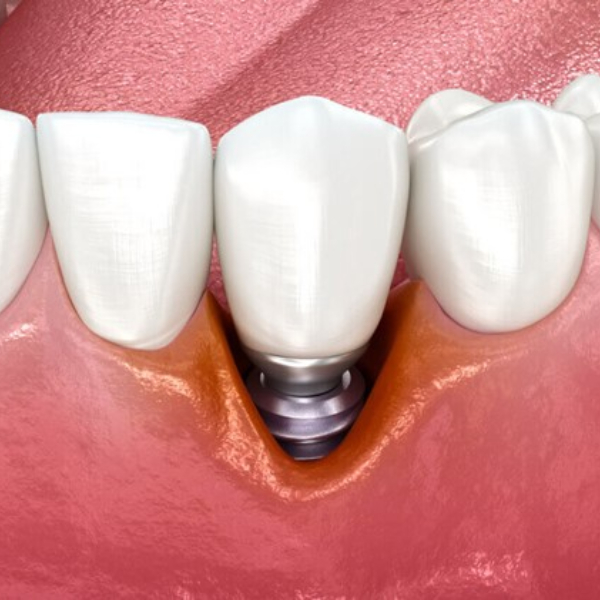 symptoms-of-dental-implant-failure